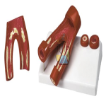 Arteriosclerosis Model Two piece Premium